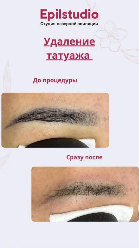 Удаление татуажа — фото 1