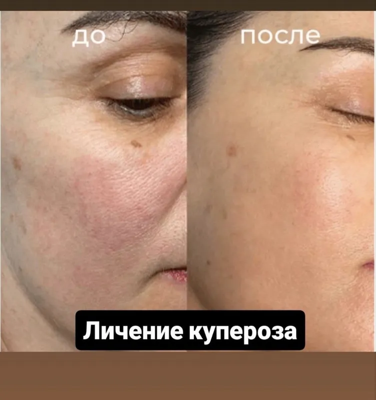 Лазерный аппарат для удаления . N yag lazer aparati. 5 Лазерный аппарат для удаления . N yag lazer aparati. 5