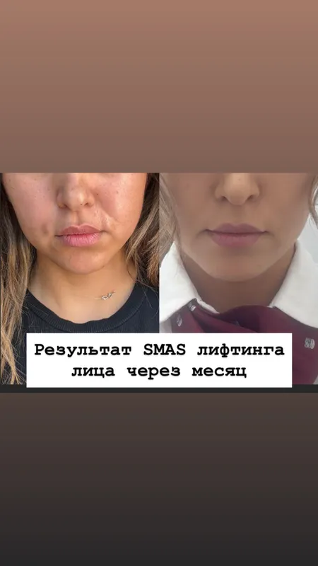 SMAS СМАС омоложение