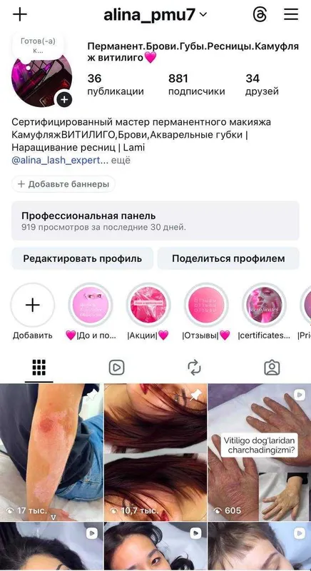 Vitiligo dog'larini kamuflyaj bilan yopish