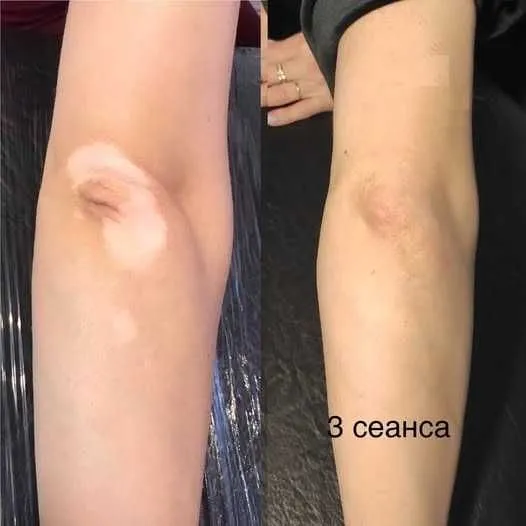 Vitiligo dog'larini kamuflyaj bilan yopish — фото 1