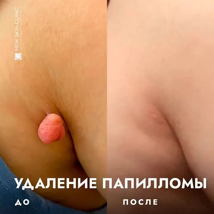 Удаление Папиломы — фото 2