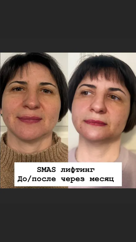 SMAS СМАС омоложение — фото 8