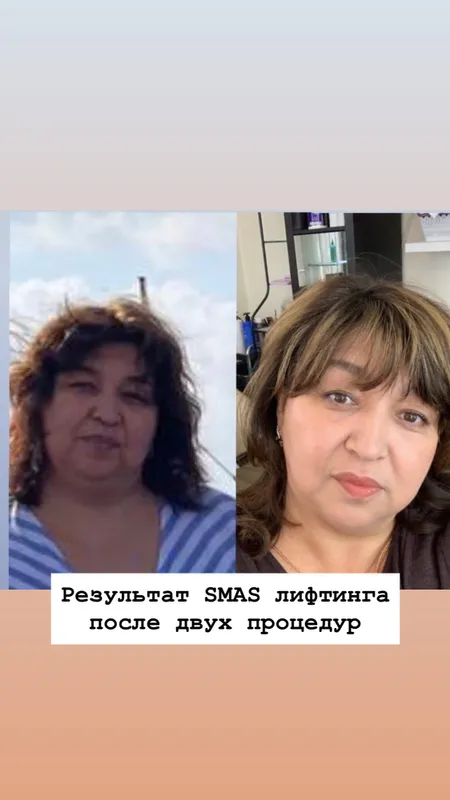 SMAS СМАС омоложение — фото 2