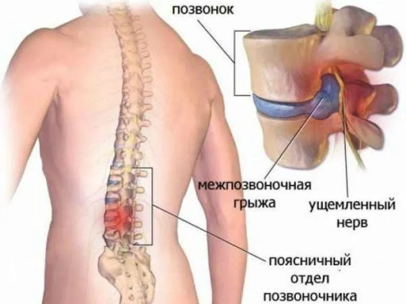 Корсет для спины ортопедический для грыжи спины, пояснично-крестцовый — фото 4