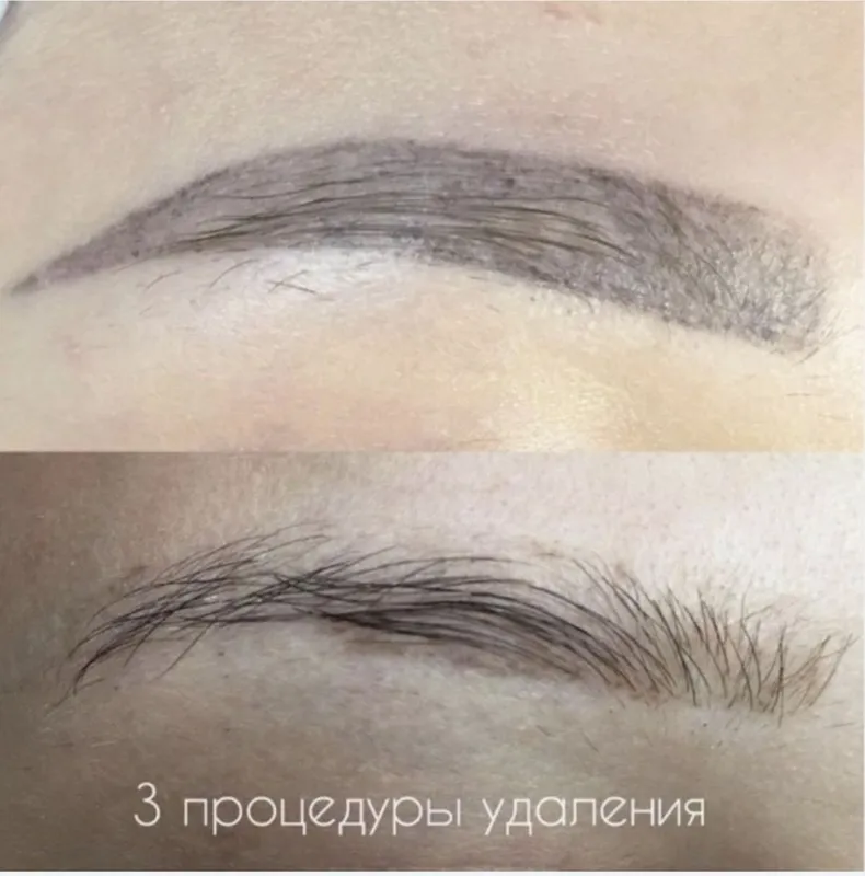 Лазерный аппарат для удаления . N yag lazer aparati. 6 Лазерный аппарат для удаления . N yag lazer aparati. 6