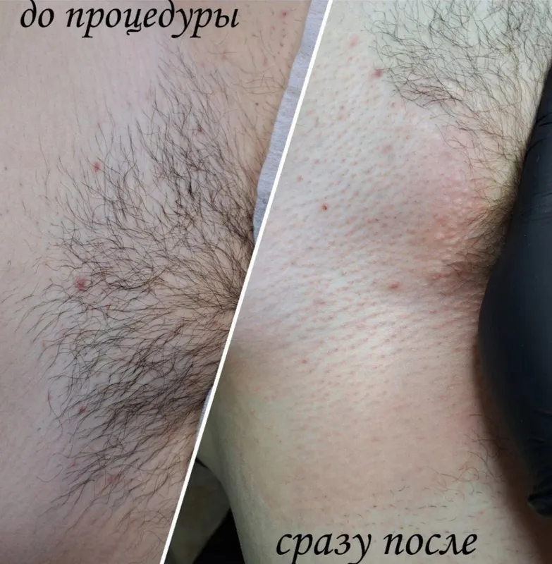 Депиляция епилатсия еркалар ва аёлар ун 4
