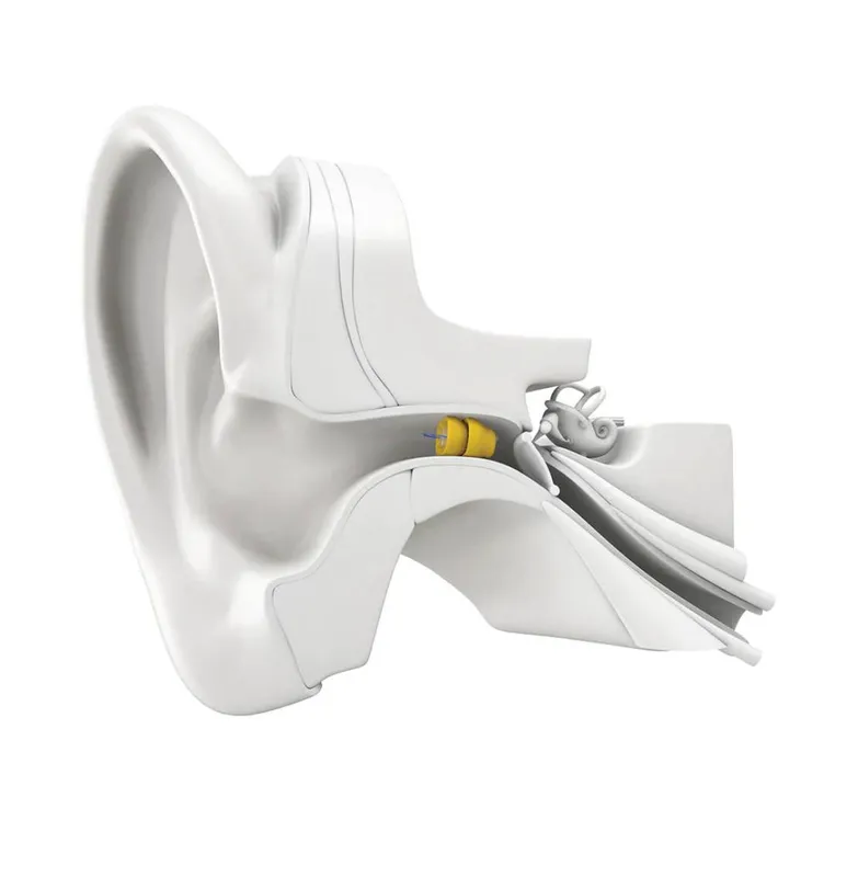 Phonak Lyric™ Слуховой аппарат — фото 2