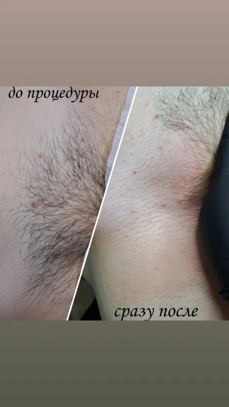 Депиляция епилатция для мужчин 2