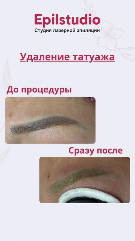 Удаление татуажа — фото 2